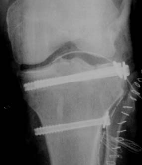 Shin fixed with 3 screws